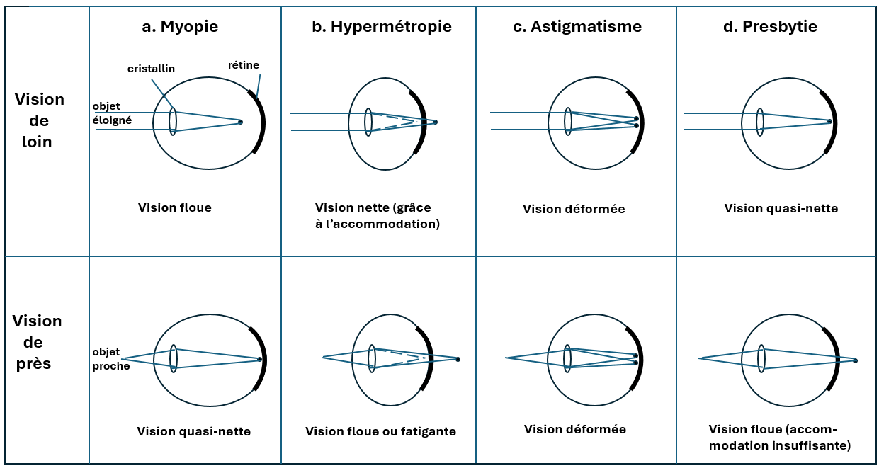 picture Types of visual disorders